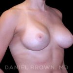 Breast Augmentation Before & After Patient #8943
