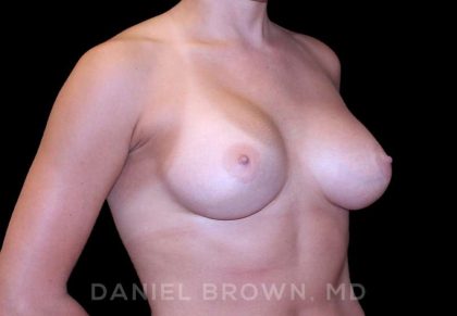 Breast Augmentation Before & After Patient #8943