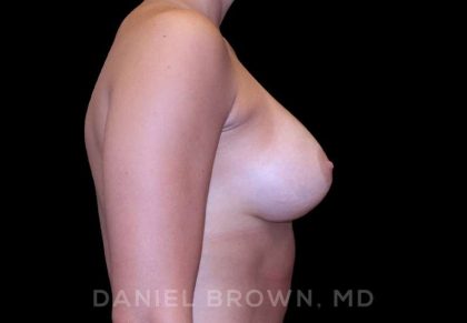 Breast Augmentation Before & After Patient #8943