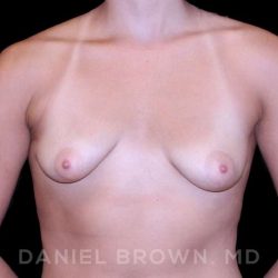Breast Augmentation Before & After Patient #8943