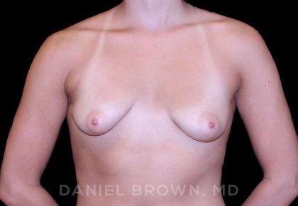Breast Augmentation Before & After Patient #8943