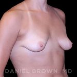 Breast Augmentation Before & After Patient #8943