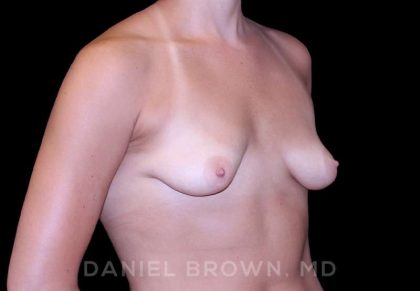Breast Augmentation Before & After Patient #8943