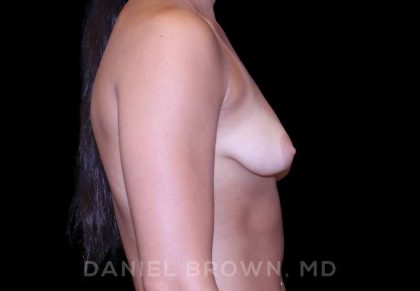 Breast Augmentation Before & After Patient #8943