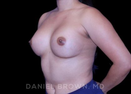 Breast Augmentation Before & After Patient #8954