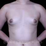 Breast Augmentation Before & After Patient #8954