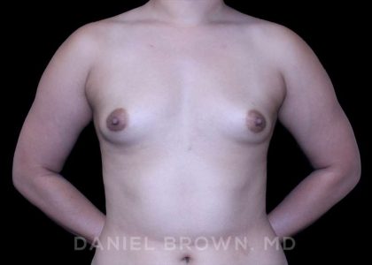Breast Augmentation Before & After Patient #8954