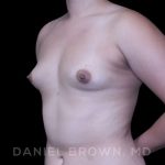 Breast Augmentation Before & After Patient #8954