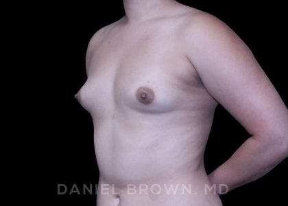 Breast Augmentation Before & After Patient #8954