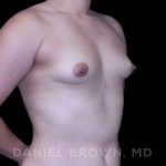 Breast Augmentation Before & After Patient #8954