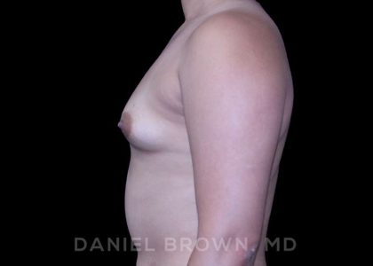 Breast Augmentation Before & After Patient #8954