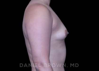 Breast Augmentation Before & After Patient #8954