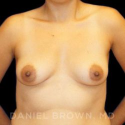 Breast Augmentation Before & After Patient #8961