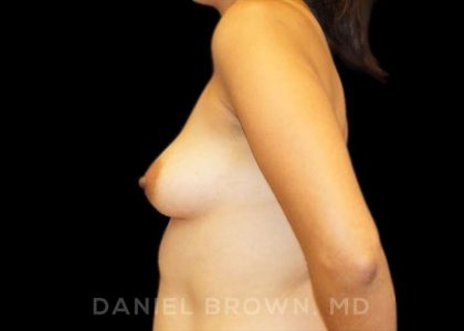 Breast Augmentation Before & After Patient #8961