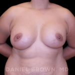 Breast Augmentation Before & After Patient #8968