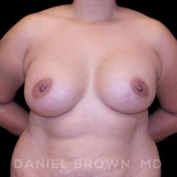 Breast Augmentation Before & After Patient #8968