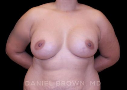 Breast Augmentation Before & After Patient #8968