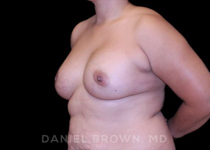 Breast Augmentation Before & After Patient #8968