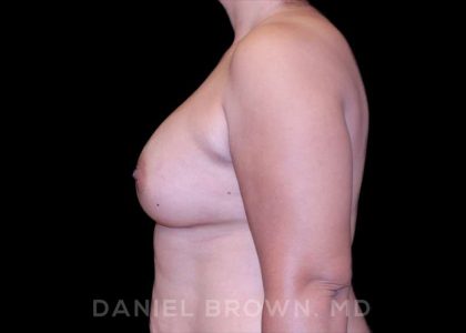 Breast Augmentation Before & After Patient #8968