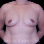 Breast Augmentation Before & After Patient #8968