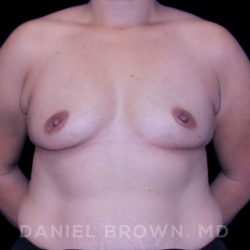 Breast Augmentation Before & After Patient #8968