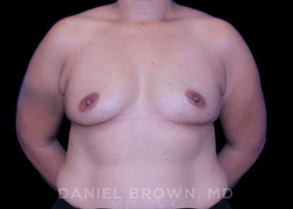 Breast Augmentation Before & After Patient #8968