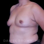 Breast Augmentation Before & After Patient #8968