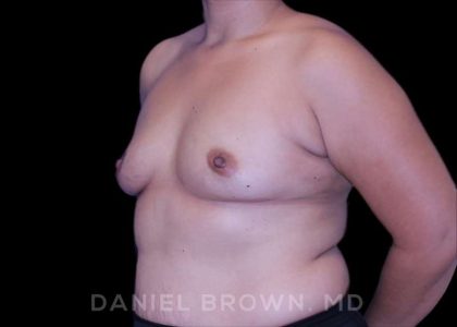 Breast Augmentation Before & After Patient #8968
