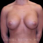 Breast Augmentation Before & After Patient #8975