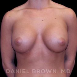Breast Augmentation Before & After Patient #8975