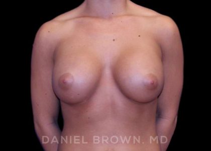 Breast Augmentation Before & After Patient #8975