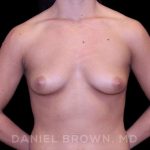 Breast Augmentation Before & After Patient #8975