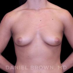 Breast Augmentation Before & After Patient #8975