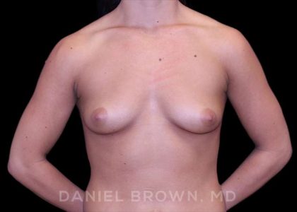Breast Augmentation Before & After Patient #8975