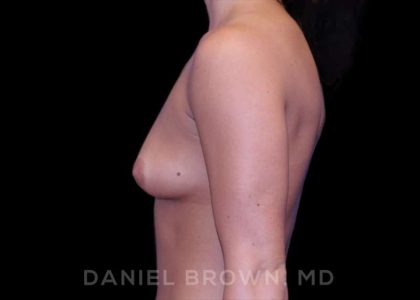 Breast Augmentation Before & After Patient #8975