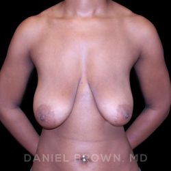 Bellesoma Breast Lift Before & After Patient #8397
