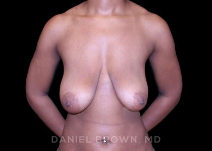 Bellesoma Breast Lift Before & After Patient #8397