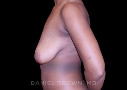 Bellesoma Breast Lift Before & After Patient #8397