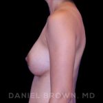 Breast Augmentation Before & After Patient #8982