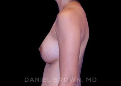 Breast Augmentation Before & After Patient #8982