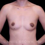 Breast Augmentation Before & After Patient #8982