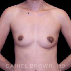 Breast Augmentation Before & After Patient #8982