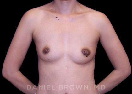 Breast Augmentation Before & After Patient #8982