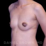 Breast Augmentation Before & After Patient #8982