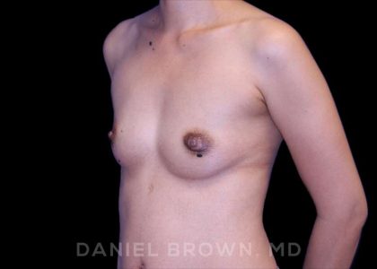 Breast Augmentation Before & After Patient #8982