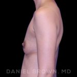 Breast Augmentation Before & After Patient #8982