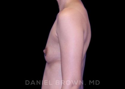 Breast Augmentation Before & After Patient #8982