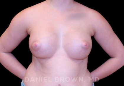 Breast Augmentation Before & After Patient #8993