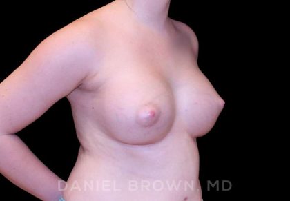 Breast Augmentation Before & After Patient #8993