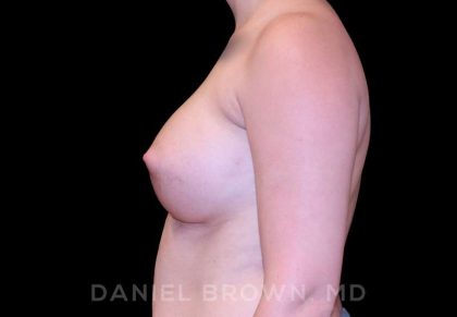 Breast Augmentation Before & After Patient #8993